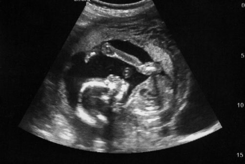 Supreme Court Inaction Grants Major Pro-Life Win