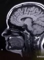 A Breakthrough for Schizophrenia? Part I: Speculation Surrounds Babies’ MRIs